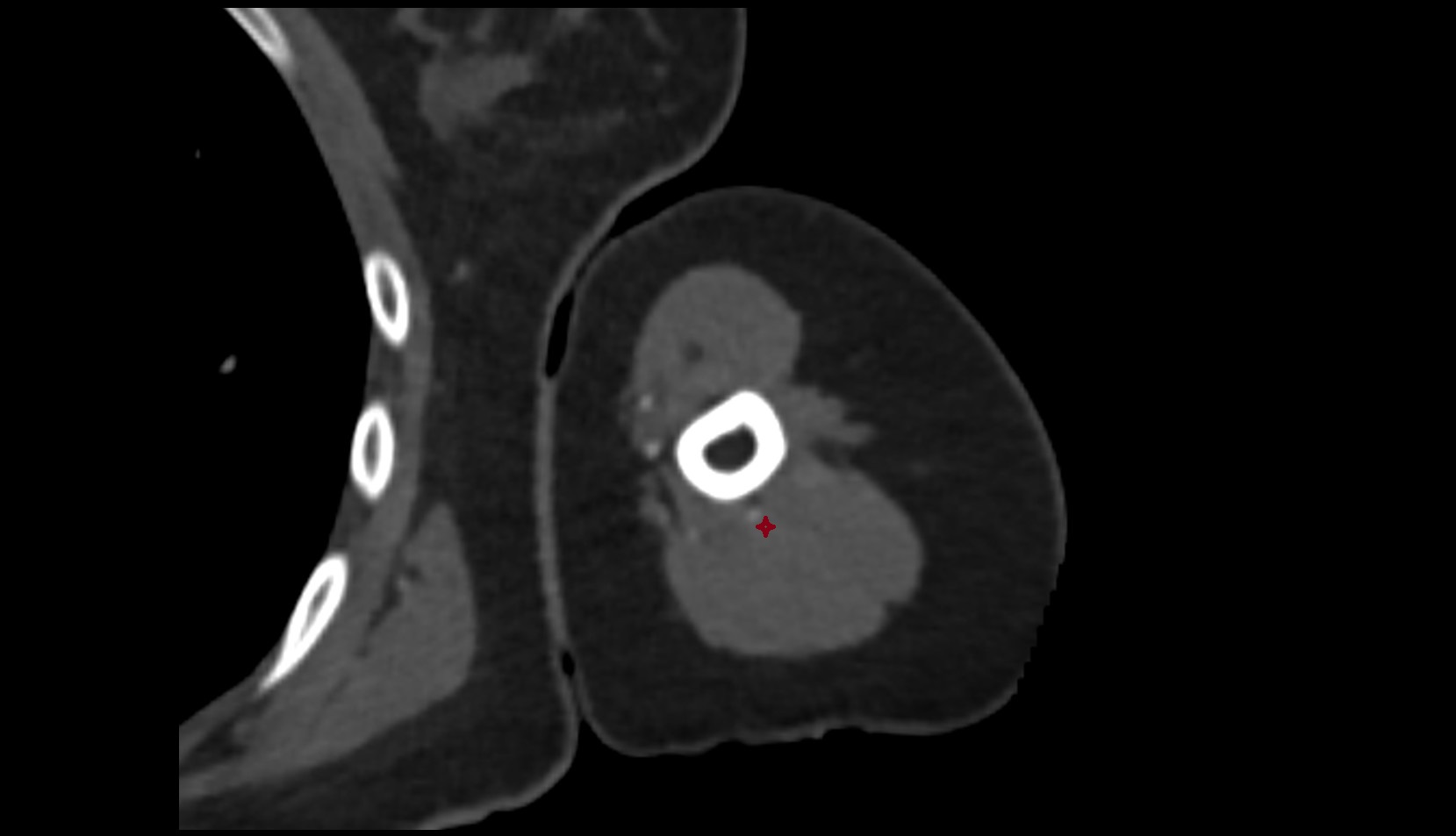 medial head of triceps brachii muscle ct axial