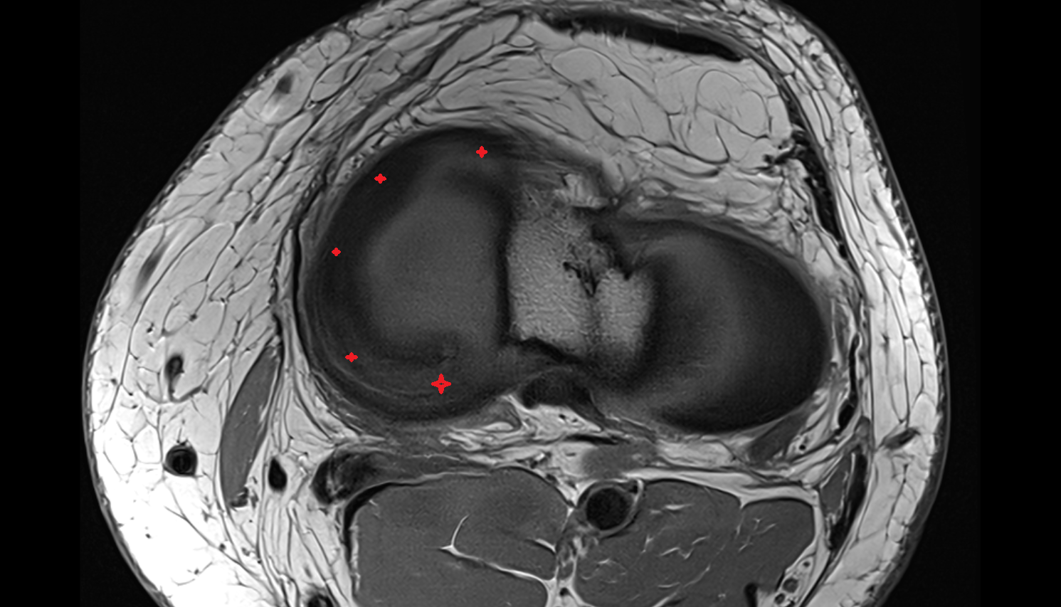 medial meniscus axial cross sectional anatomy 3T MRI AI enhanced  radiology  anatomy image-img-00000-00000