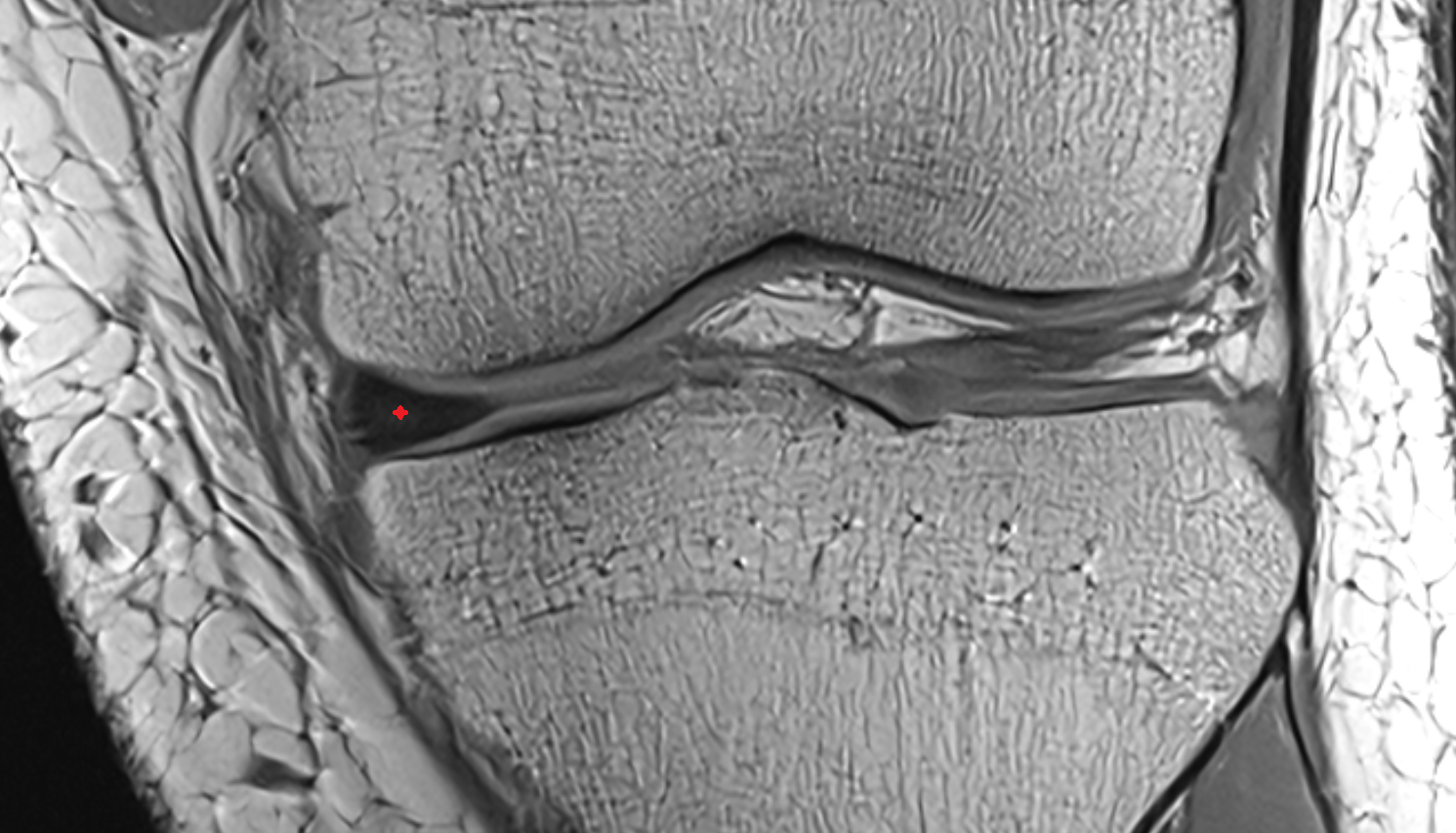 medial meniscus coronal cross sectional anatomy 3T MRI AI enhanced  radiology  anatomy image-img-00000-00000