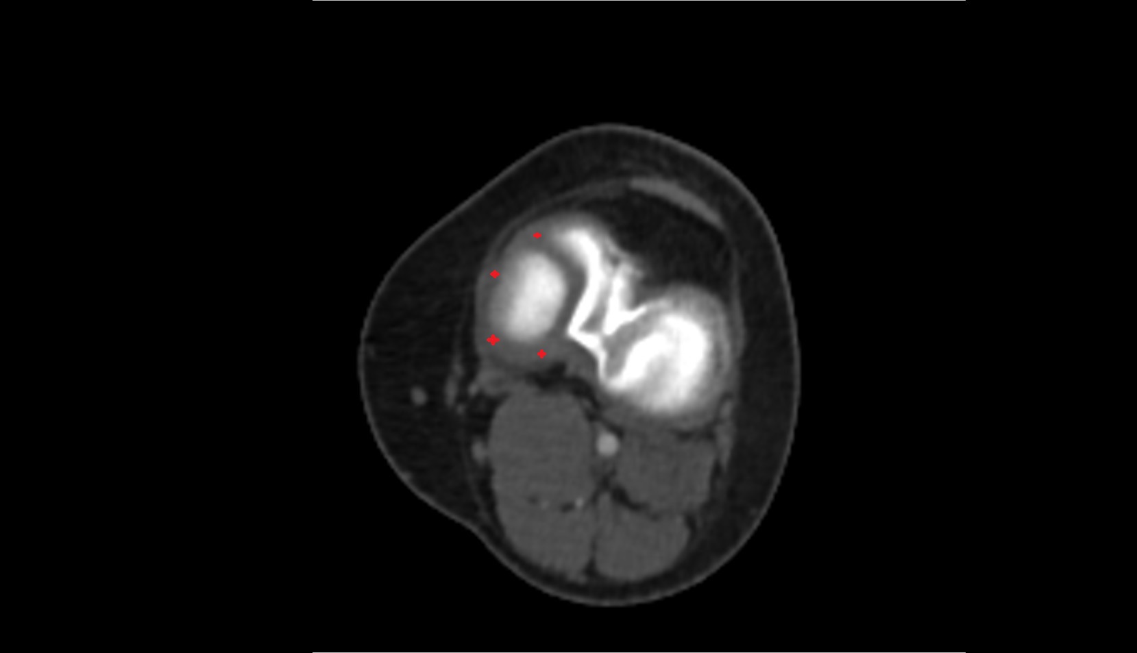 medial meniscus ct axial