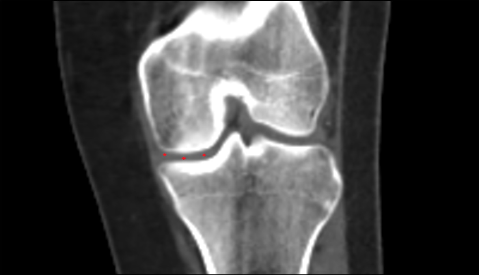 medial meniscus ct coronal image