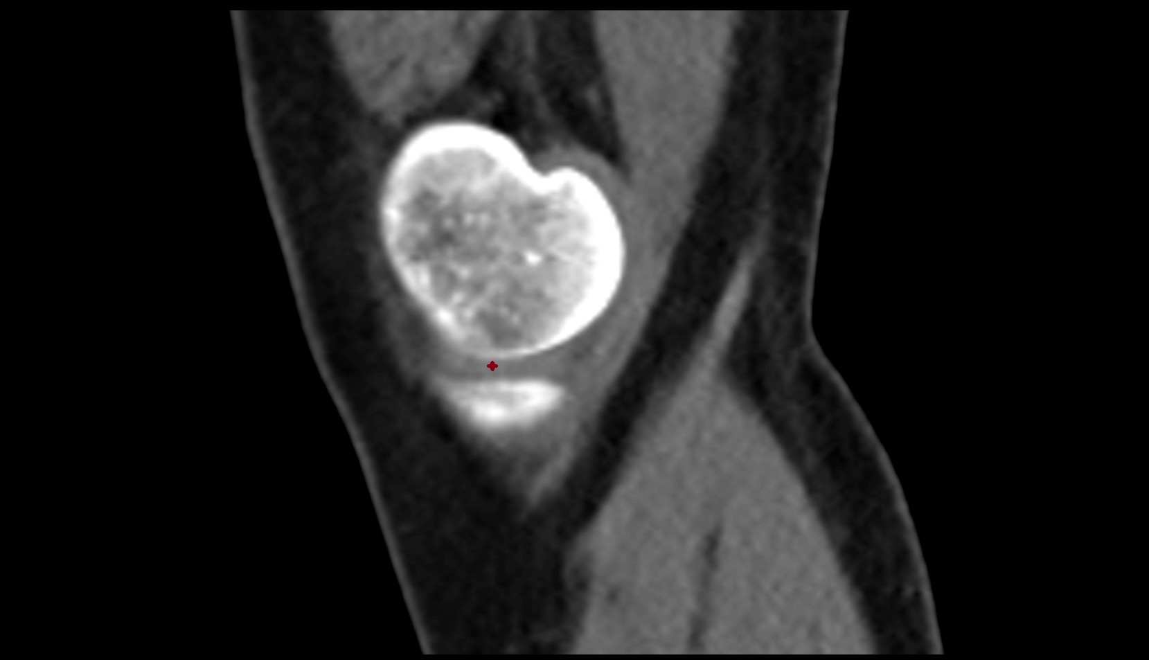 medial meniscus ct sag image
