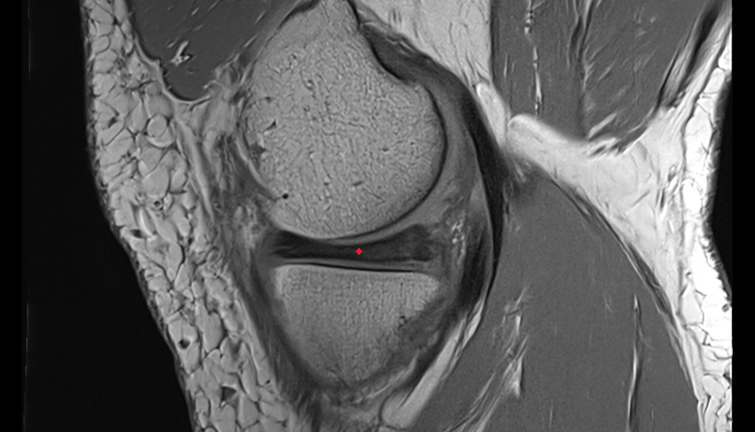 medial meniscus  sagittal  cross sectional anatomy 3T MRI AI enhanced  radiology  anatomy image-img-00000-00000