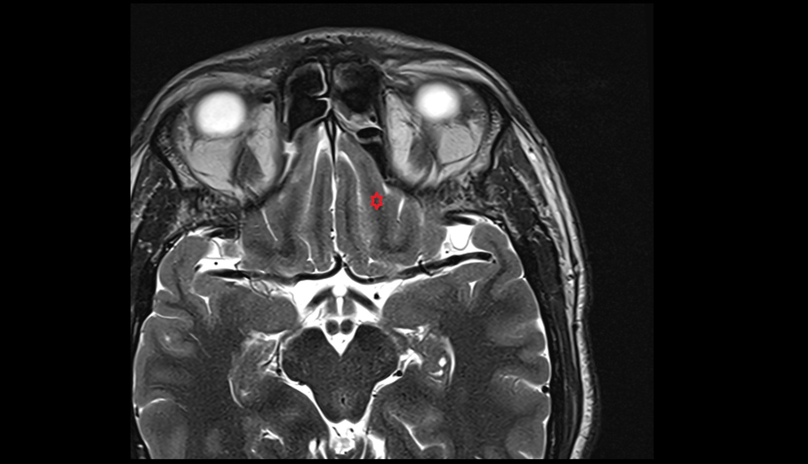 medial orbital gyrus MRI 3T axial image