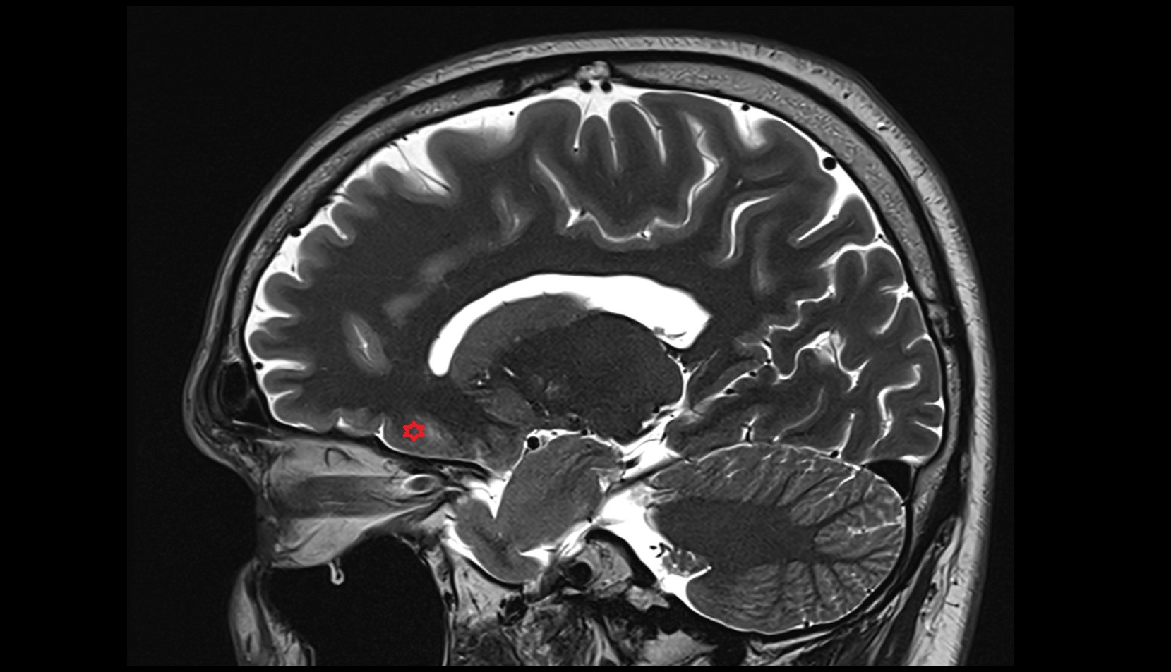 medial orbital gyrus MRI 3T sagittal image