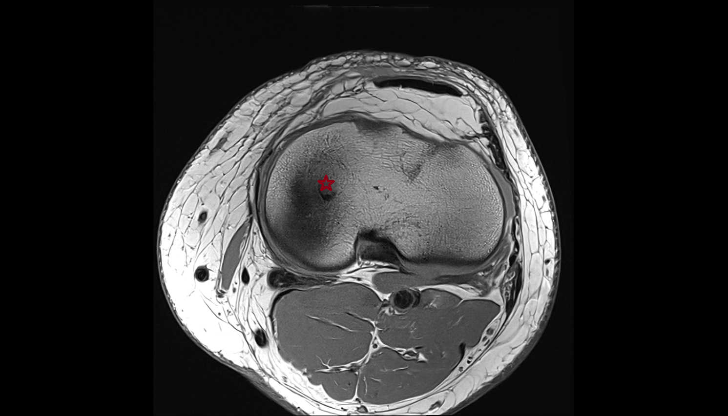 medial tibial plateau  axial cross sectional anatomy 3T MRI AI enhanced  radiology  anatomy image-img-00000-00000
