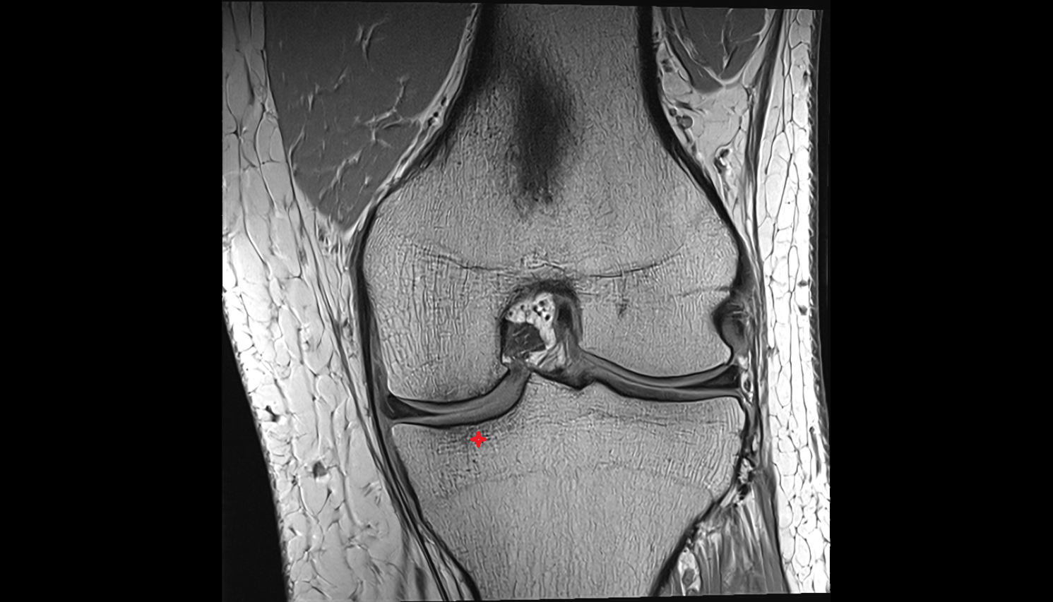 medial tibial plateau coronal cross sectional anatomy 3T MRI AI enhanced  radiology  anatomy image-img-00000-00000