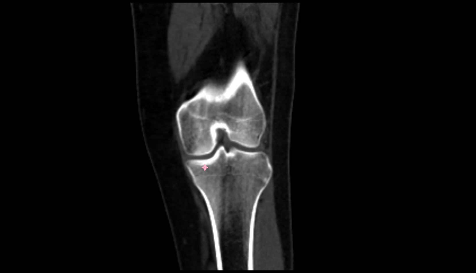 medial tibial plateau ct coronal image