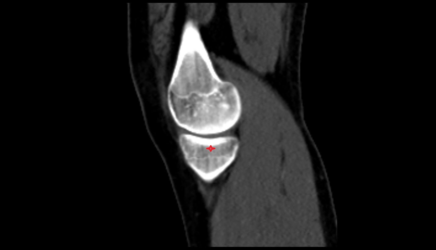 medial tibial plateau ct sag
