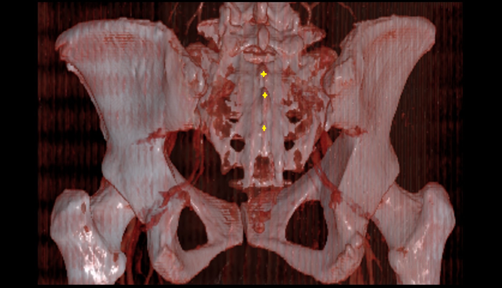 median sacral crest cr 3d vrt image