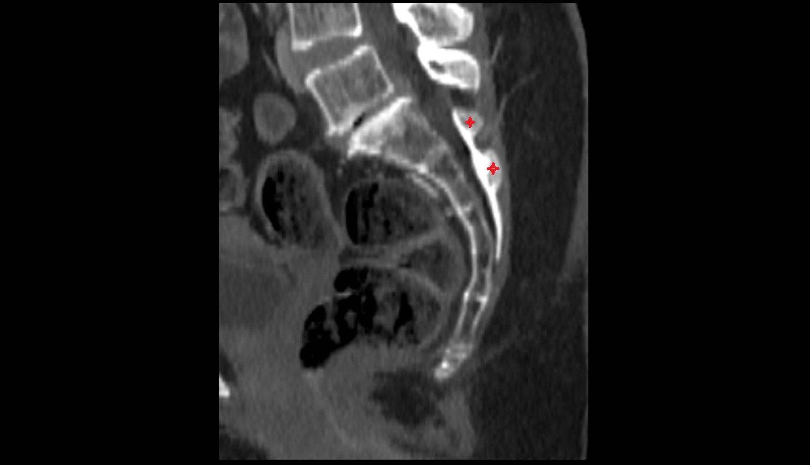 median sacral crest ct sag image