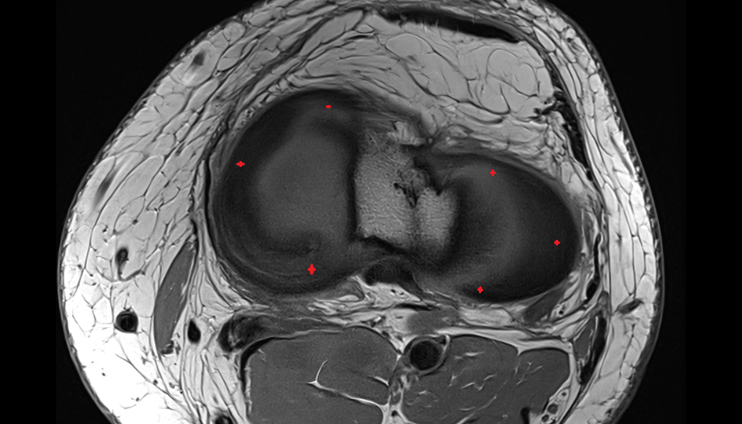 meniscus cartilage axial cross sectional anatomy 3T MRI AI enhanced  radiology  anatomy image-img-00000-00000