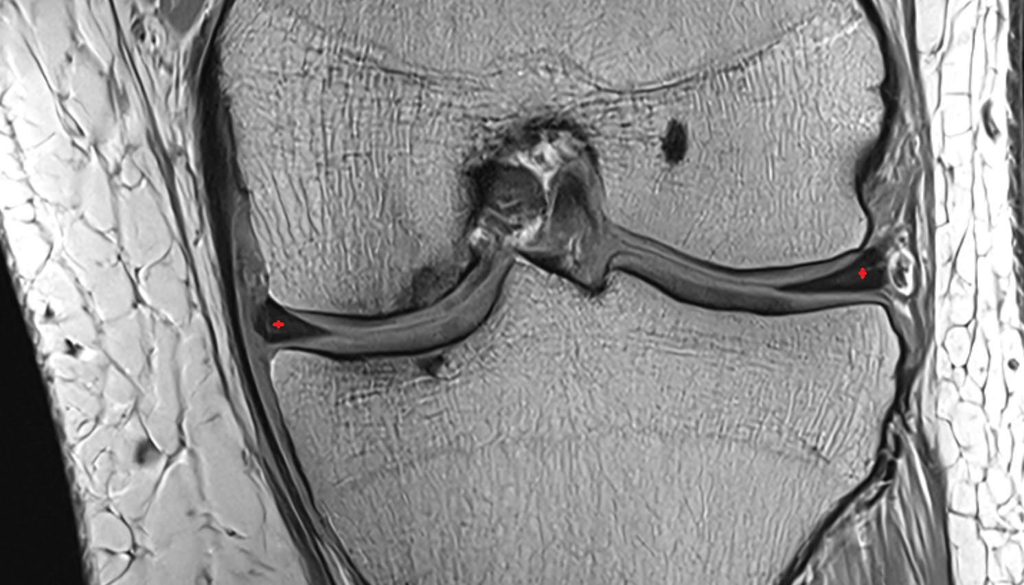 meniscus cartilage coronal  cross sectional anatomy 3T MRI AI enhanced  radiology  anatomy image-img-00000-00000