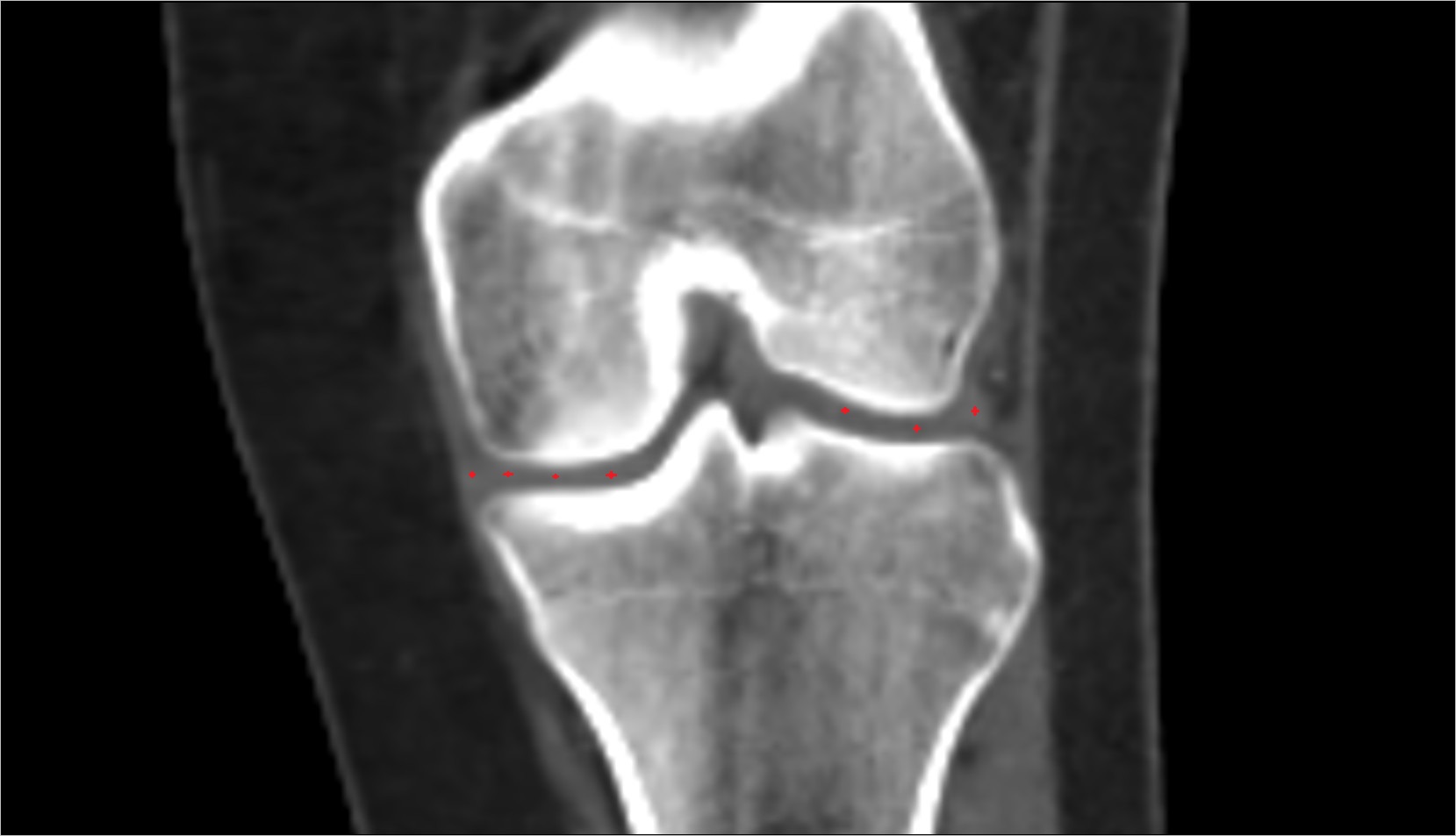 meniscus cartilage ct image