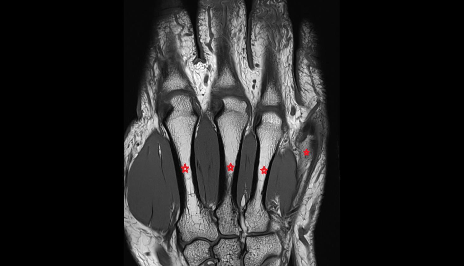 metacarpal bones coronal cross sectional anatomy 3T MRI AI enhanced radiology image-img-00000-00000