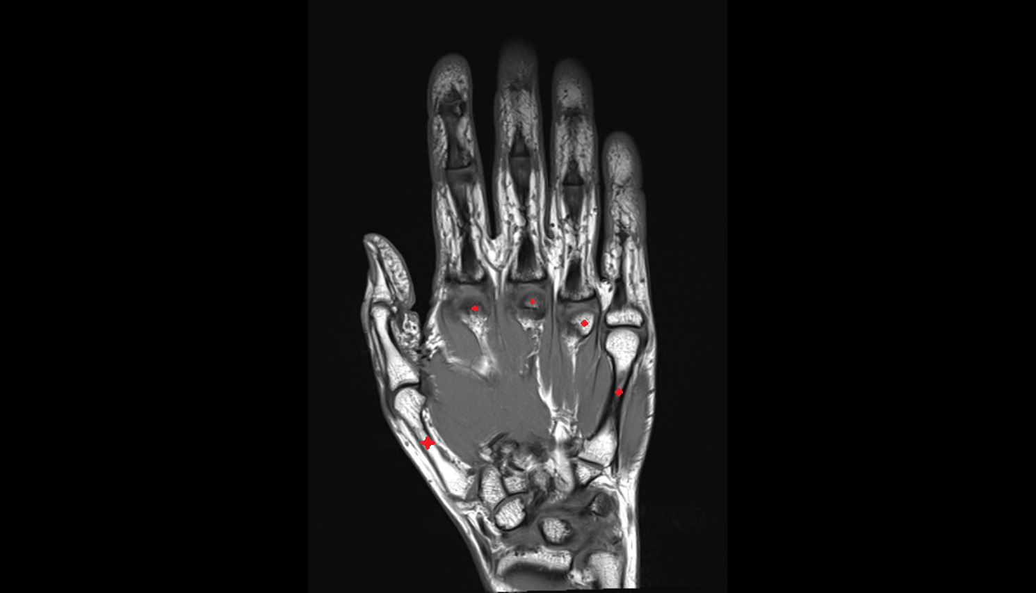 metacarpal bones coronal cross sectional anatomy 3T MRI AI enhanced radiology image-img-00000-00000_00001