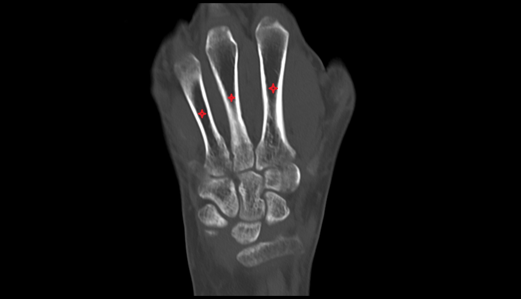 metacarpal bones ct coronal