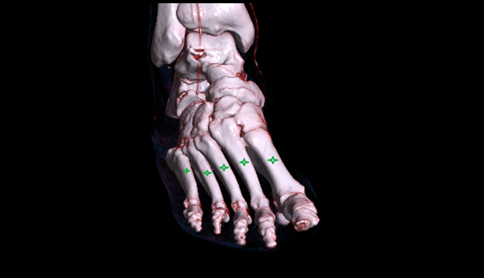 Metatarsal bones 3D
