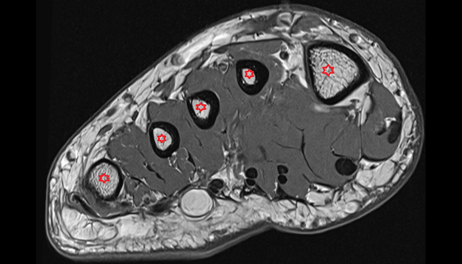 metatarsal bone  mri  anatomy labelled image-img-00000-00000