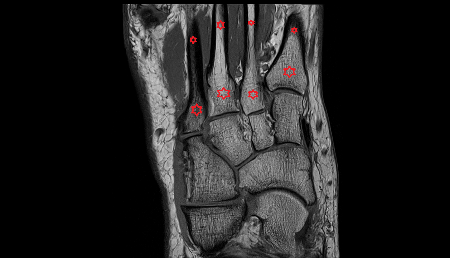 metatarsal bone  mri  anatomy labelled image-img-00000-00000_00001