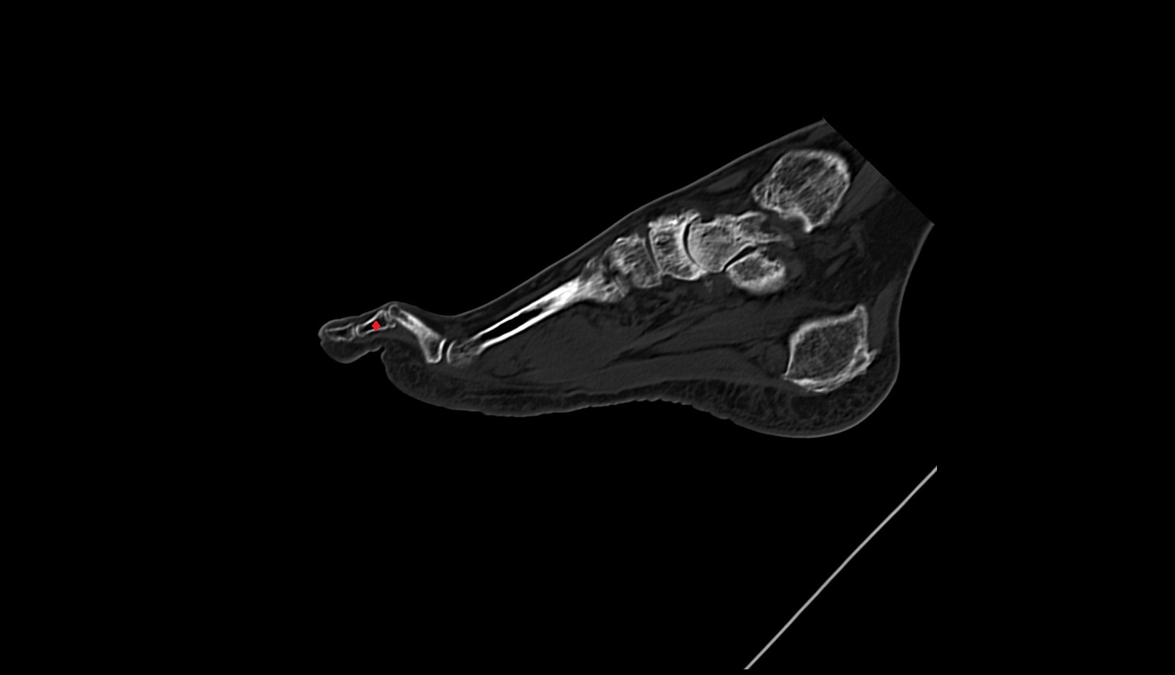 middle phalanx foot CT sagittal anatomy image