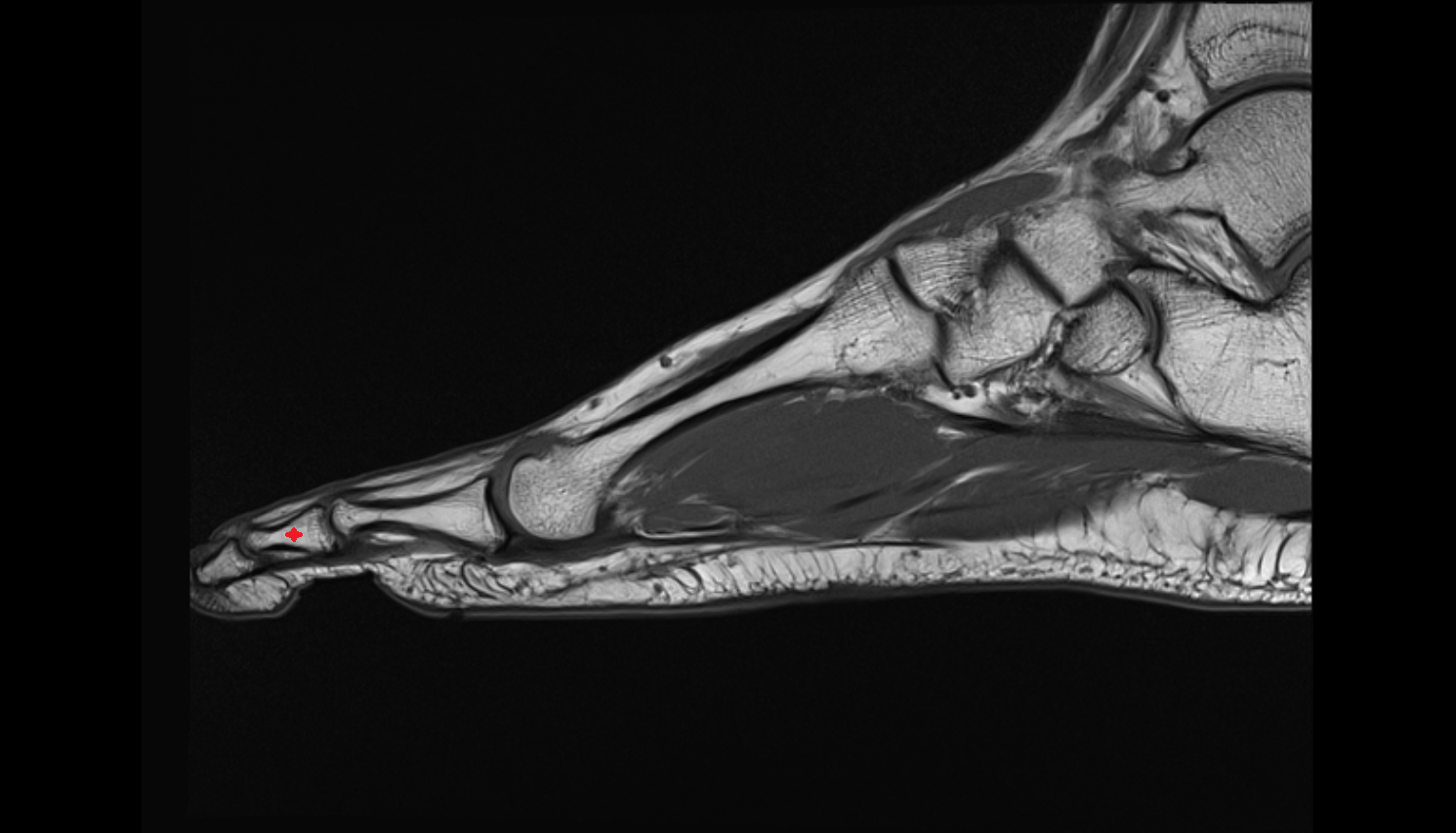 middle phalanx foot SAG cross sectional anatomy 3T MRI AI enhanced radiology image-img-00000-00000