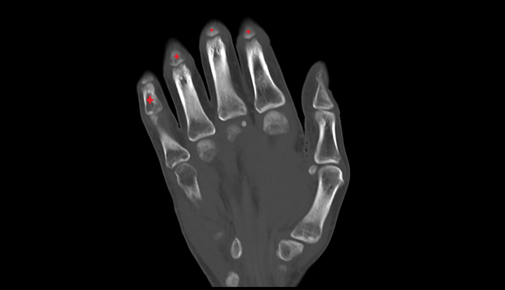 middle phalanx of hand CORONAL CT IMAGE 1