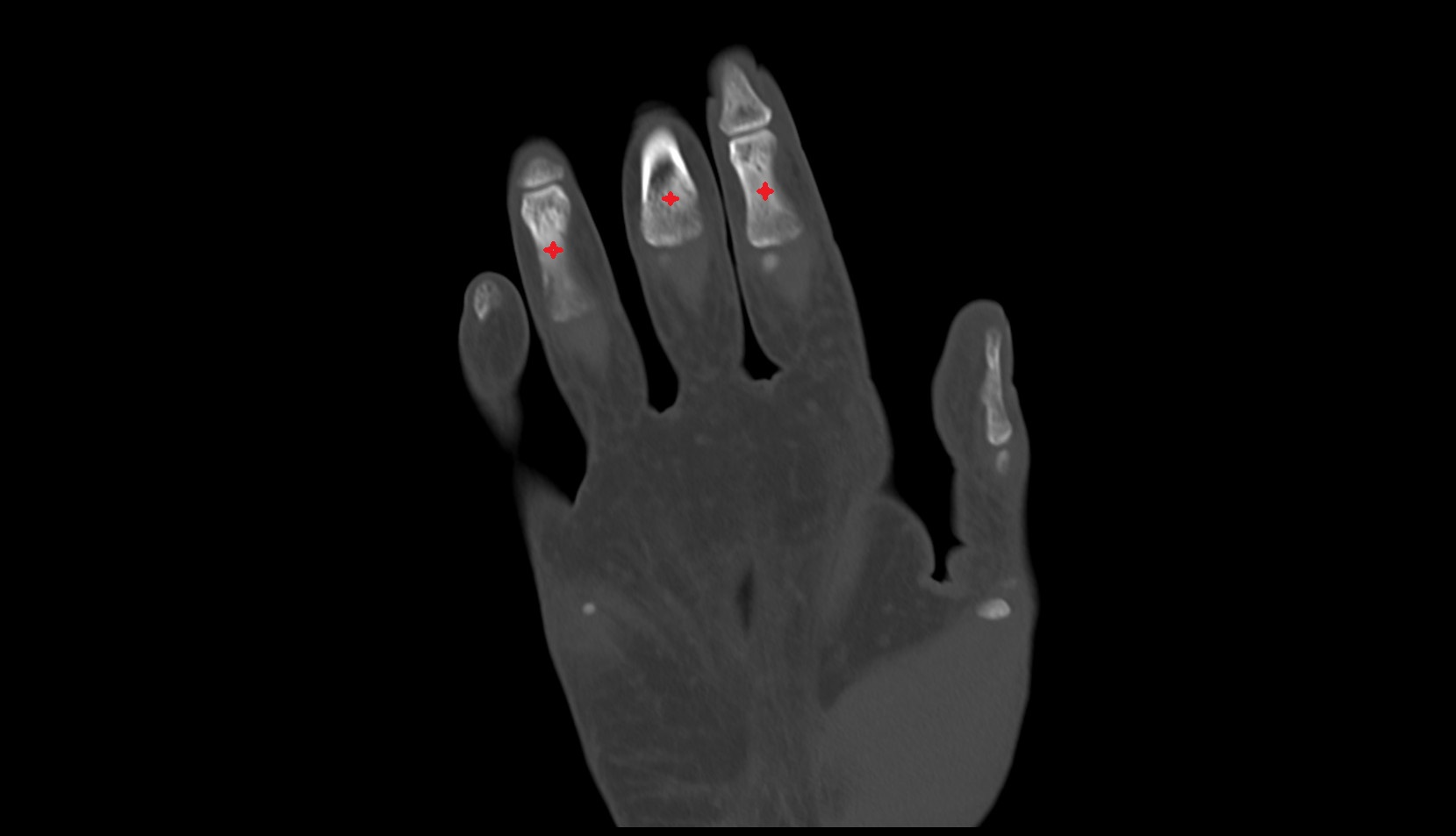 middle phalanx of hand CORONAL CT IMAGE 2