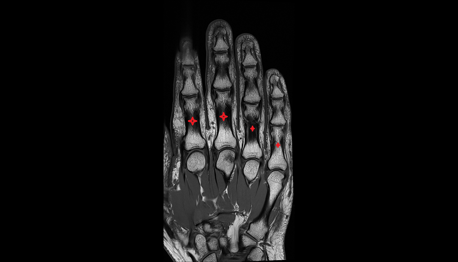 middle phalanx of hand coronal cross sectional anatomy 3T MRI AI enhanced radiology image-img-00000-00000