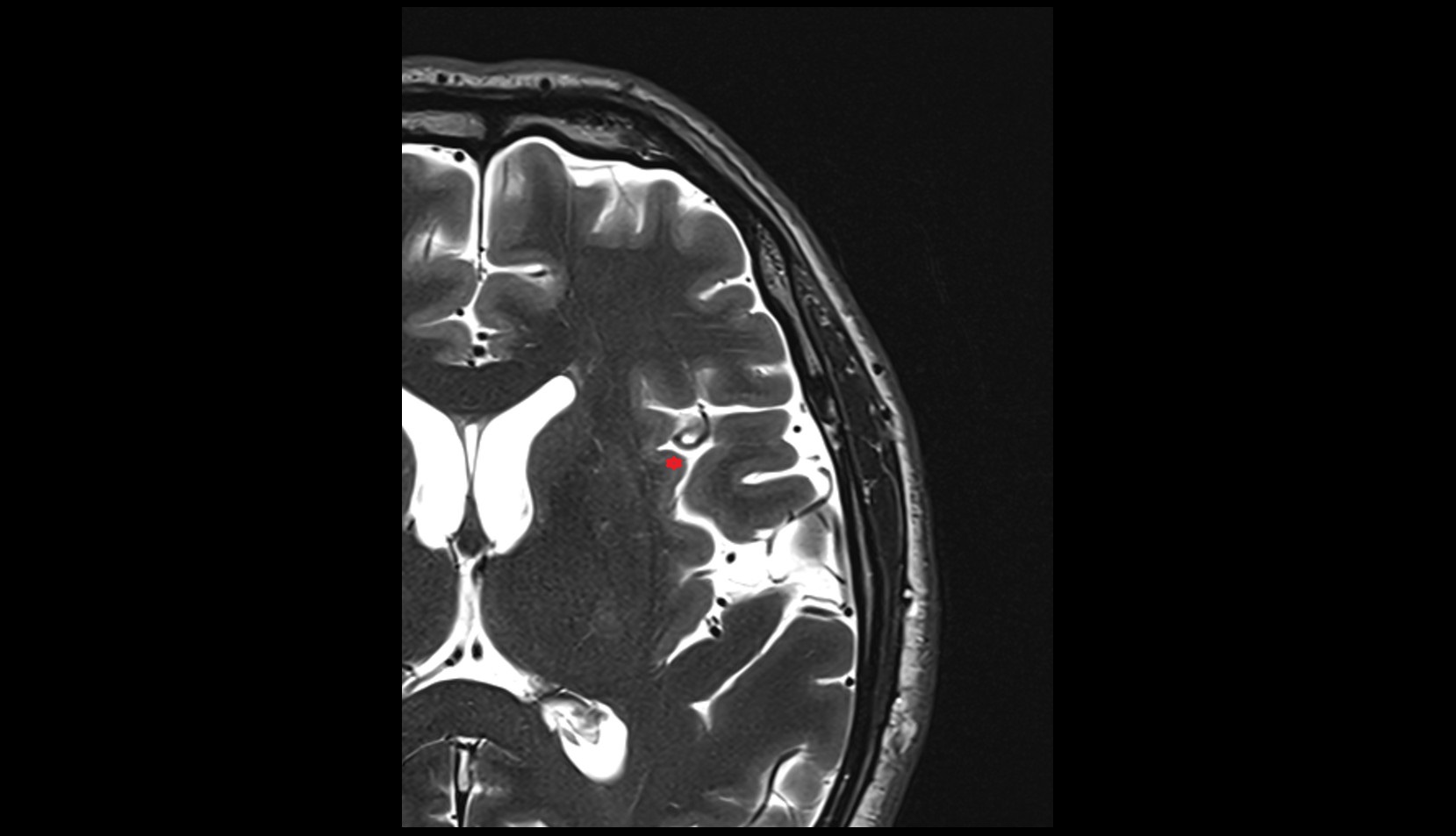 middle short insular gyrus mri 3t axial image