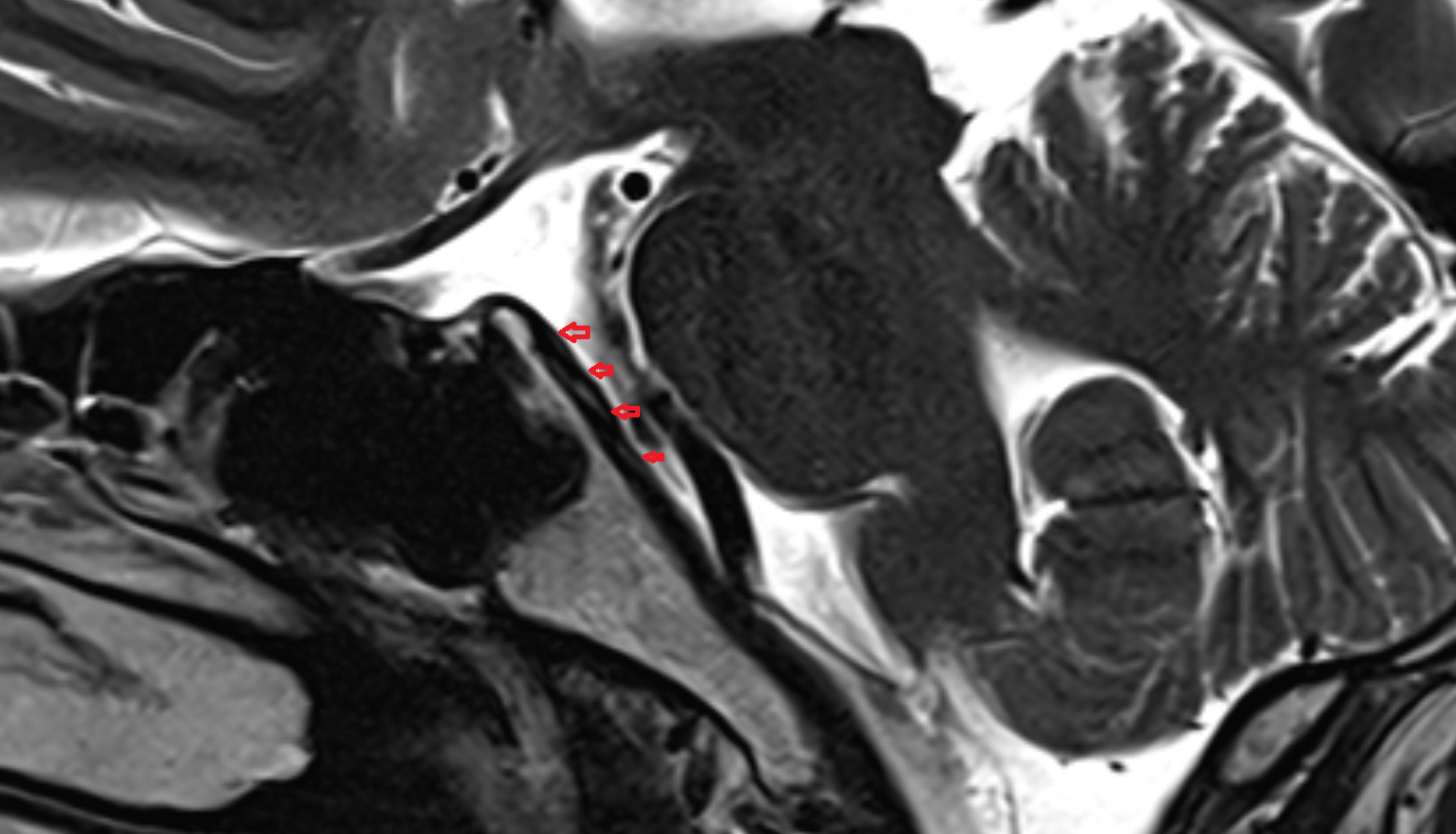 mri  Basilar venous plexus sag anatomy image -img-00000-00000