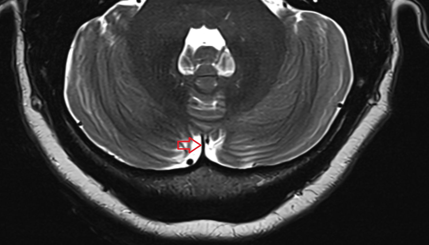 mri  Cerebellar falx (falx cerebelli) axial anatomy image -img-00000-00000