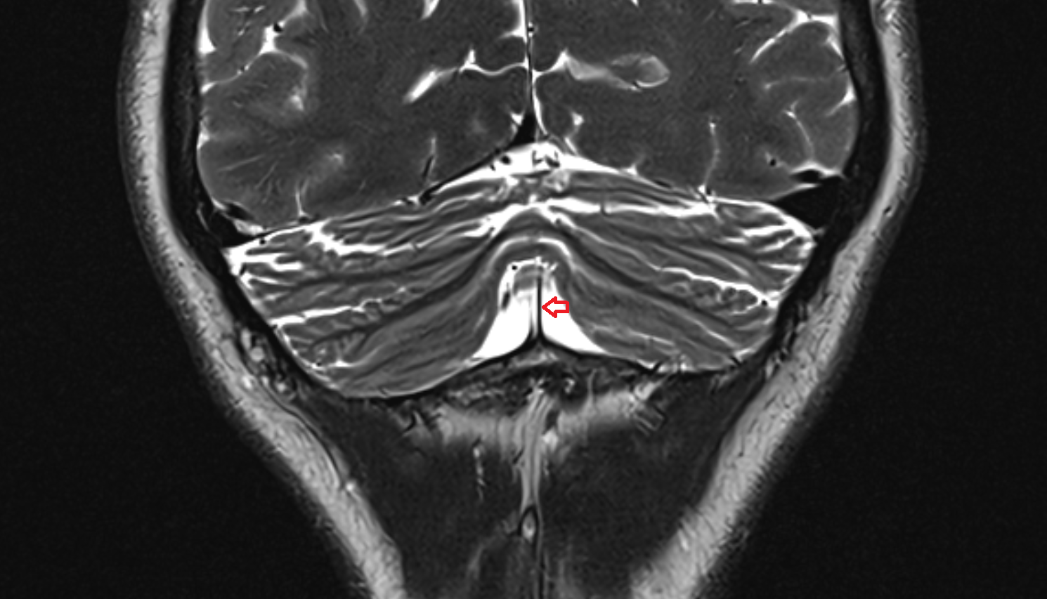 mri  Cerebellar falx (falx cerebelli) coronal anatomy image -img-00000-00000