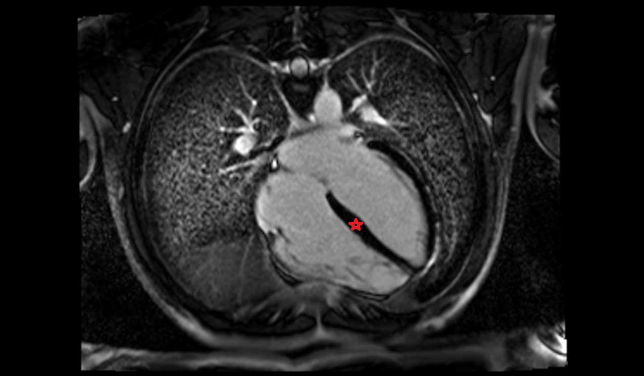 mri image Interventricular Septum anatomy