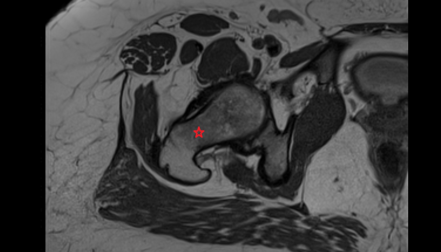 neck of femur  MRI  axial  anatomy  image-img-00000-00000