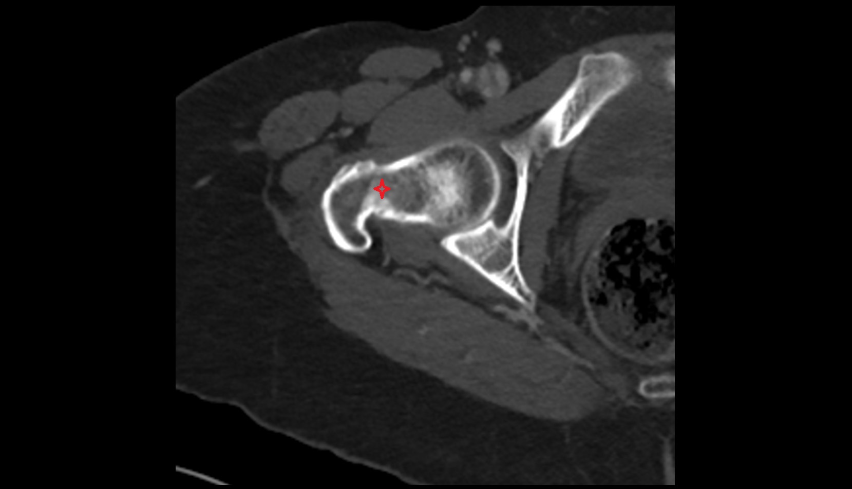 neck of femur ct axial