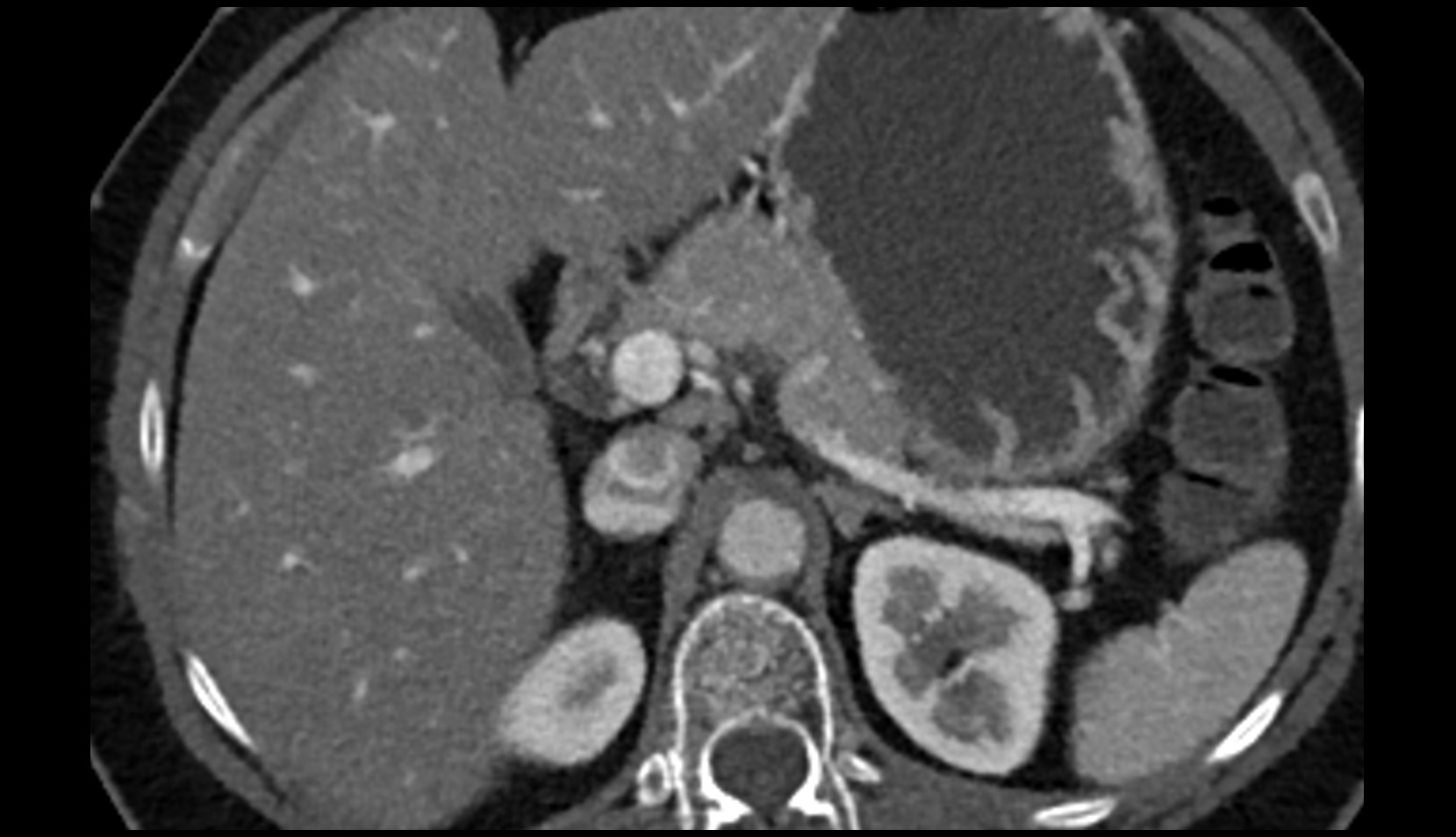 neck of gallbladder CT  axial image