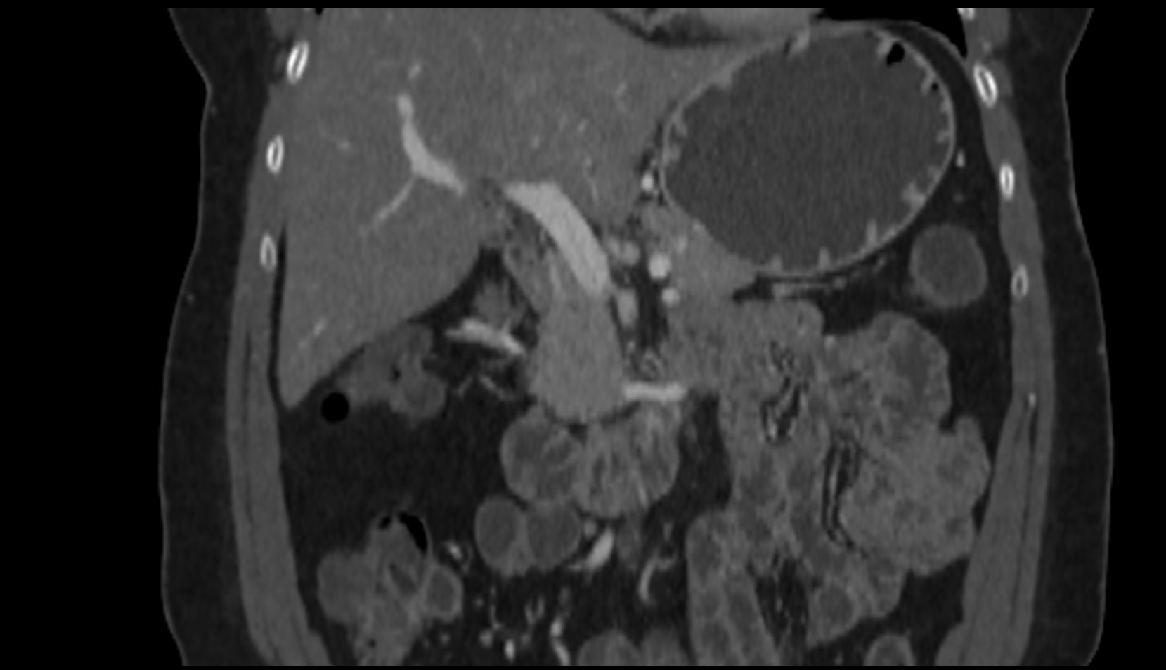 neck of gallbladder CT coronal image