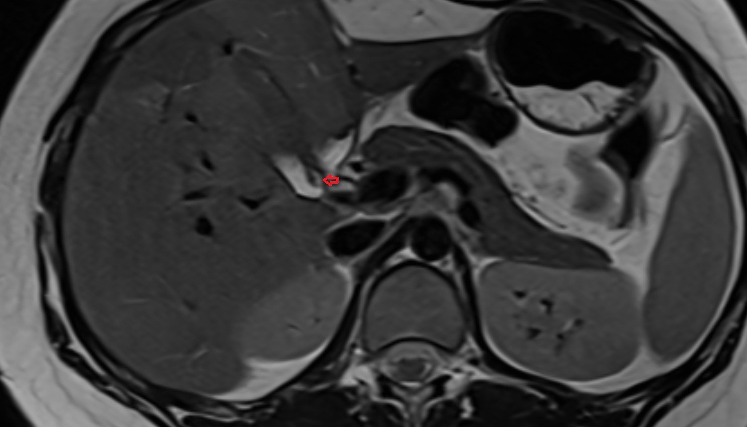 neck of gallbladder axial mri  anatomy  image -img-00000-00000