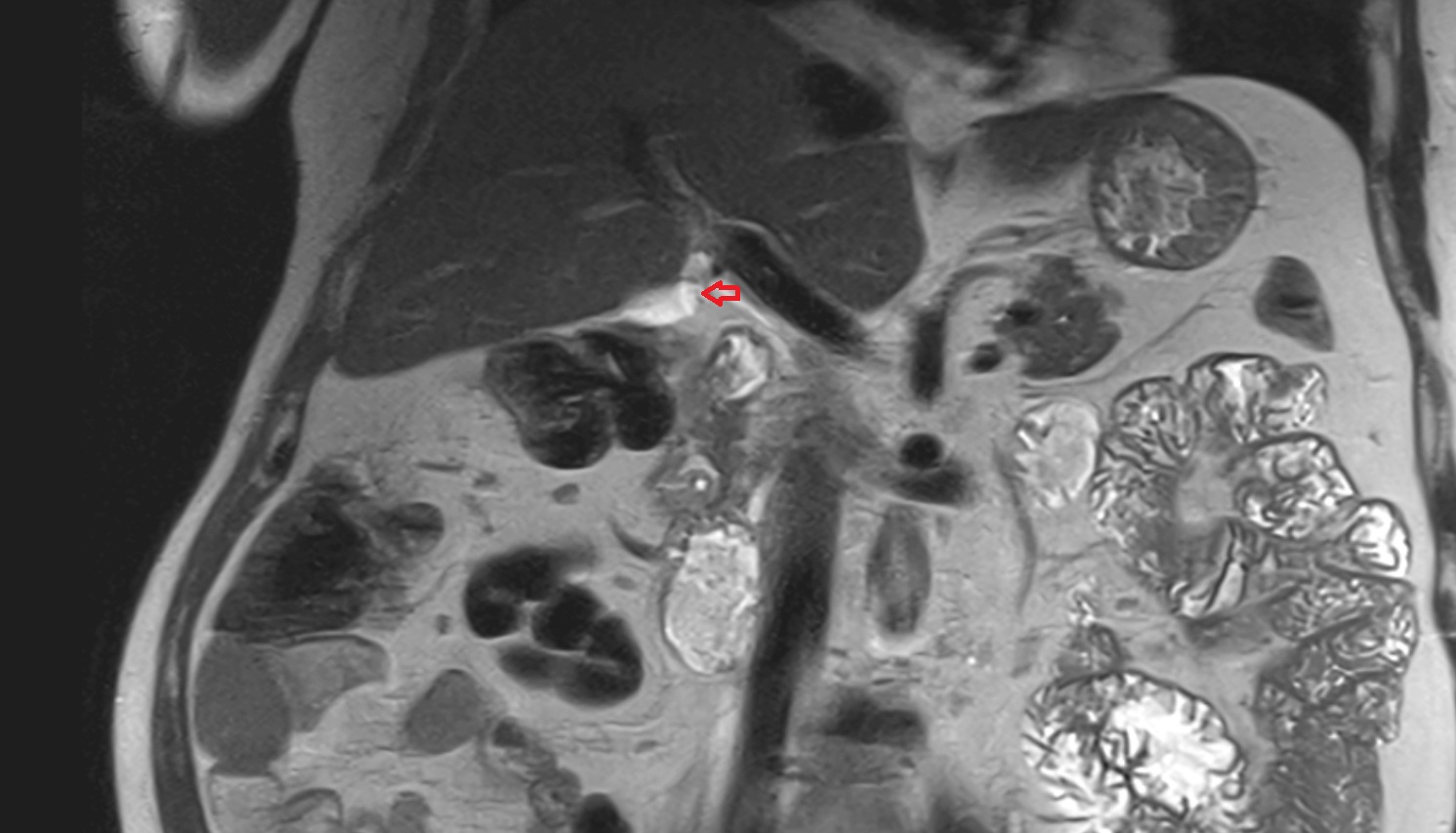 neck of gallbladder coronal  anatomy  image -img-00000-00000