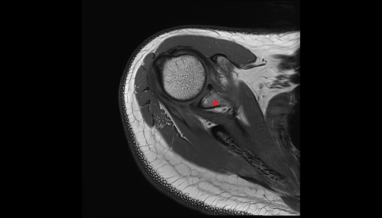 neck of scapula MRI axial  image -img-00000-00000