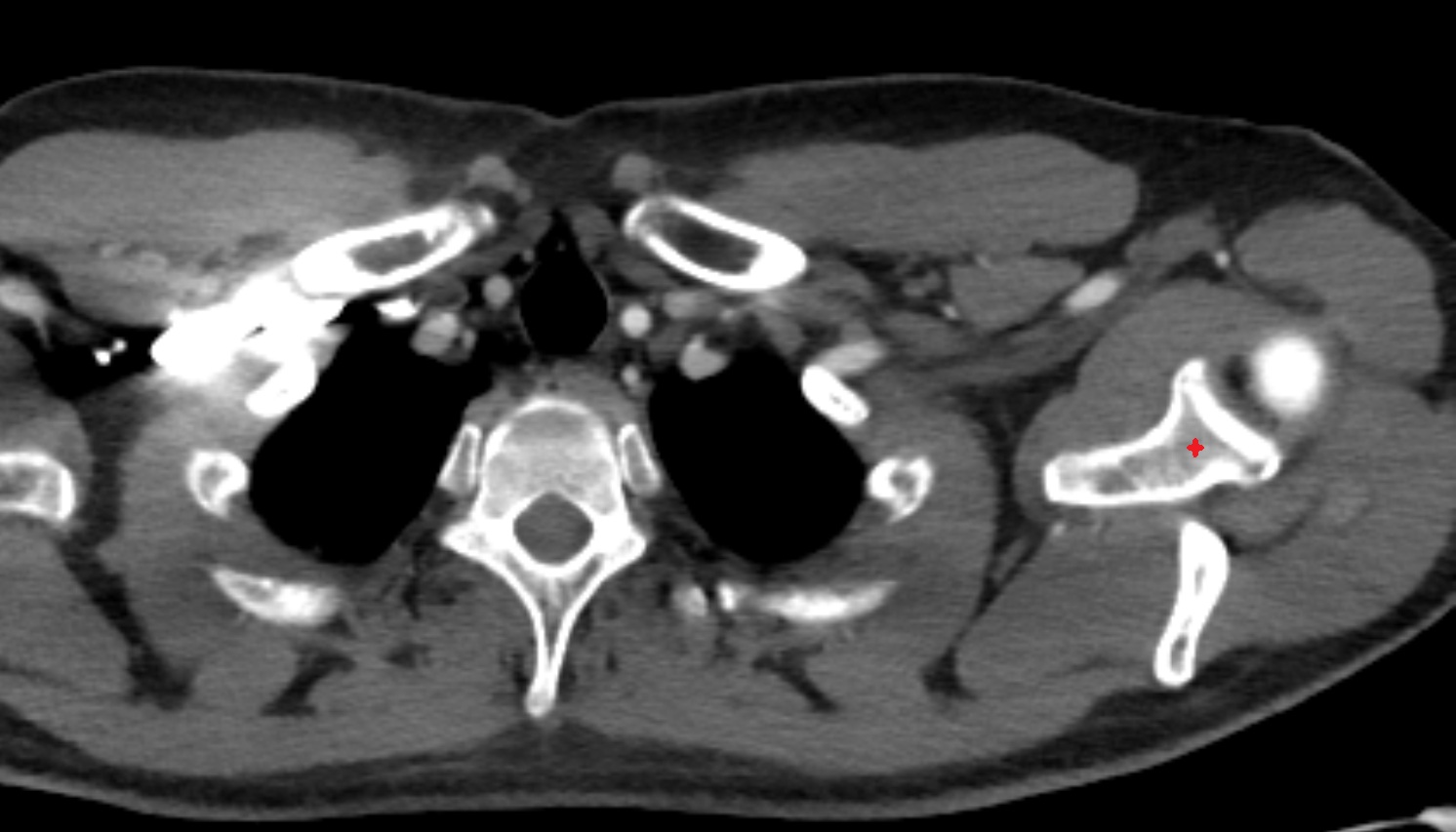 neck of scapula anatomy CT axial  image -img-00000-00000