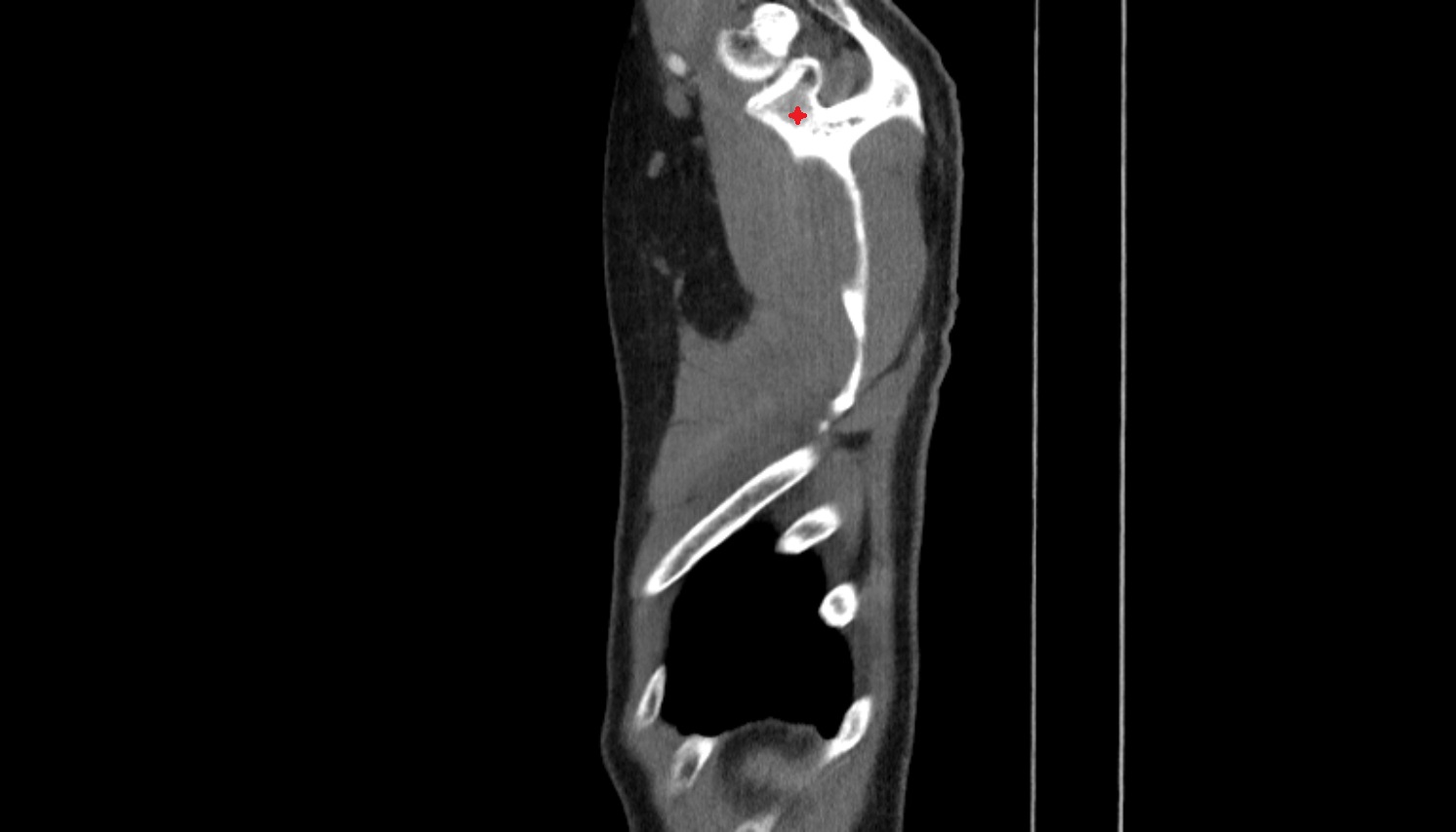 neck of scapula anatomy CT sagittal  image -img-00000-00000