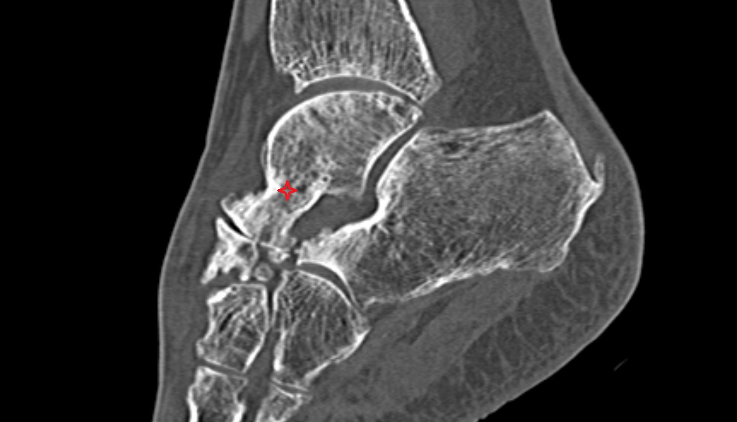 neck of the Talus CT cross sectional anatomy radiology image-img-00000-00000