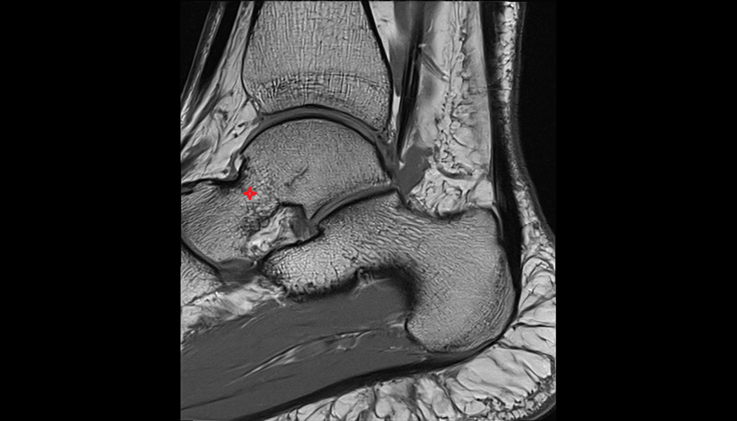 neck of the Talus agittal MRI cross sectional anatomy 3T MRI AI enhanced radiology image-img-00000-00000