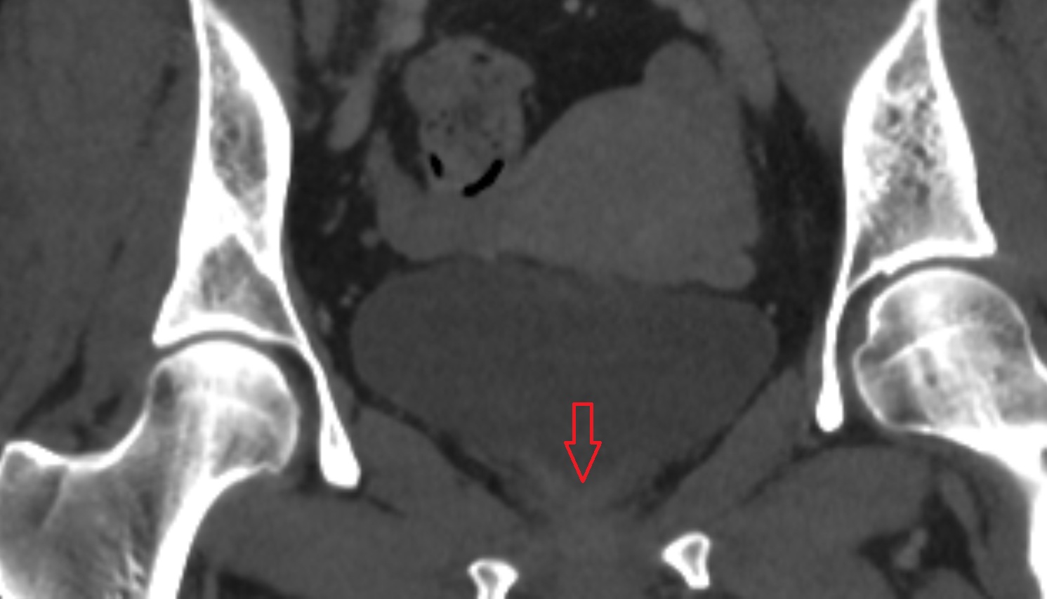 neck   of urinary bladder  ct coronal  anatomy  image-img-00000-00000