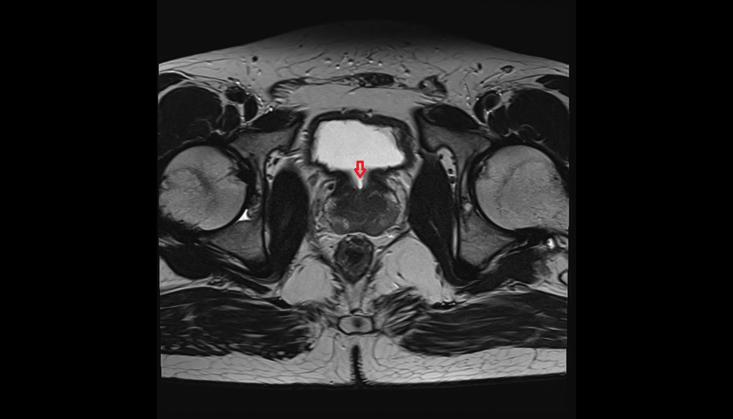 neck  of urinary bladder  mri axial  anatomy  image-img-00000-00000