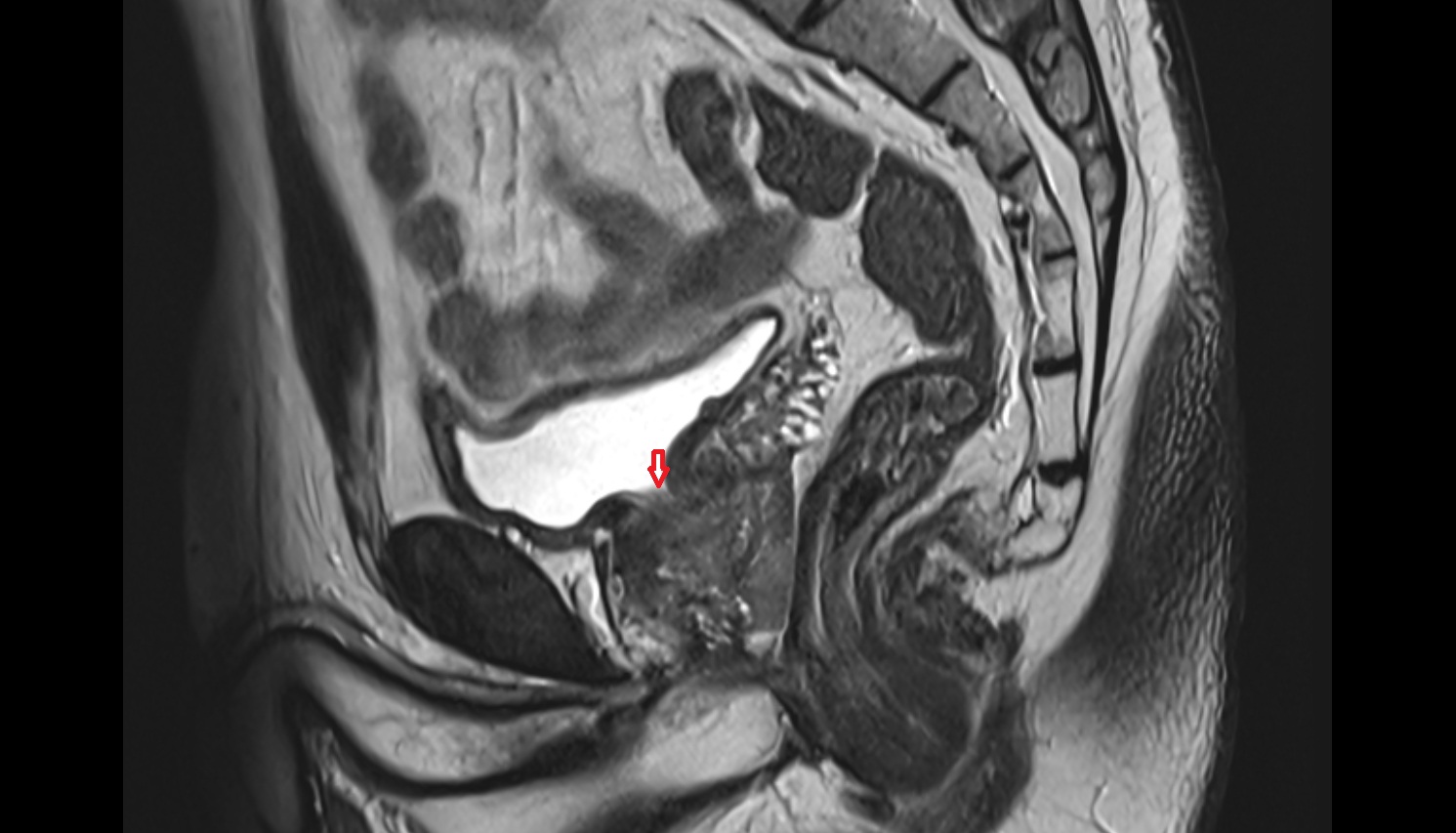 neck  of urinary bladder  mri sagittal  anatomy  image-img-00000-00000