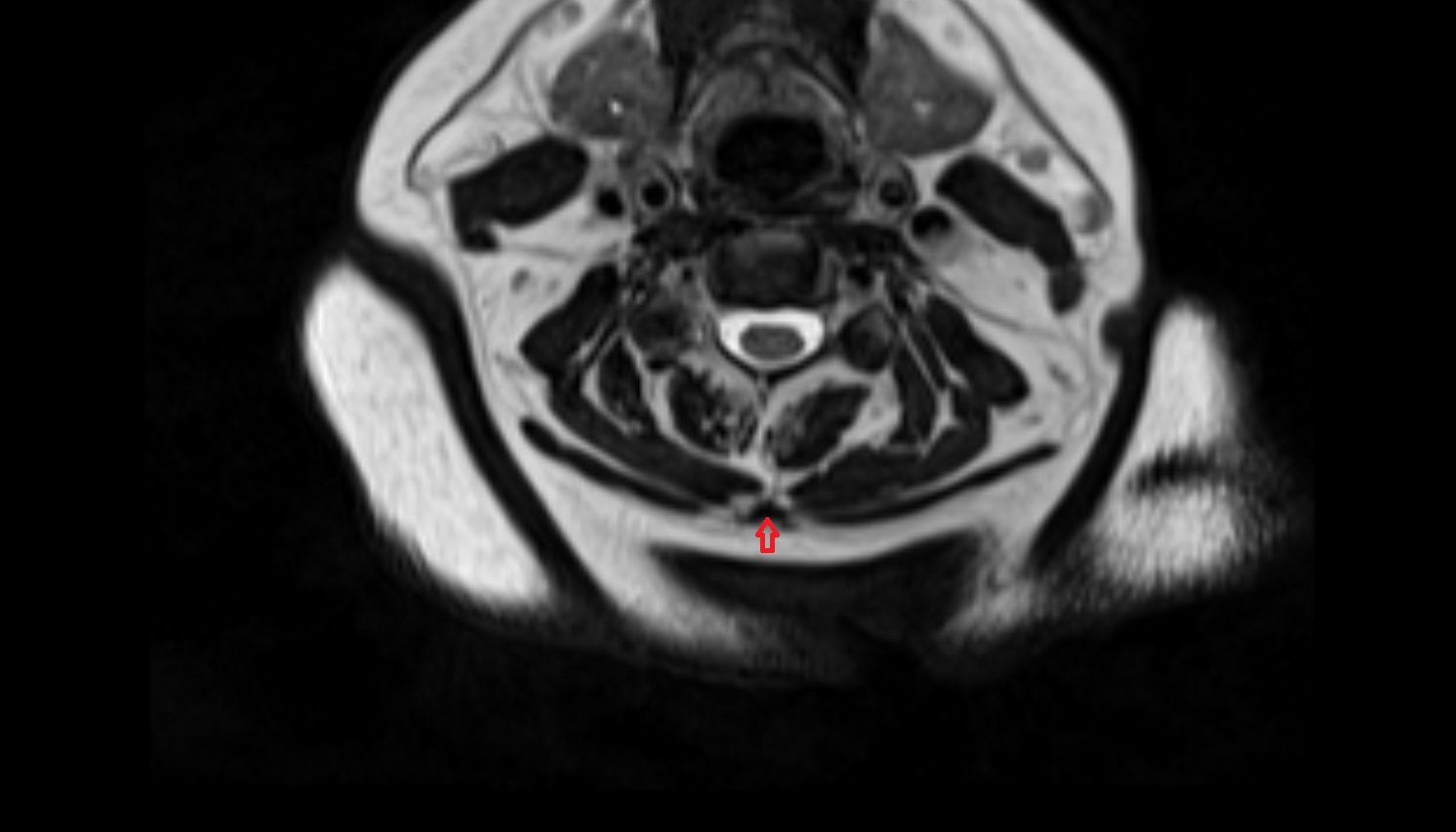 nuchal ligament axial mri image -img-00000-00000