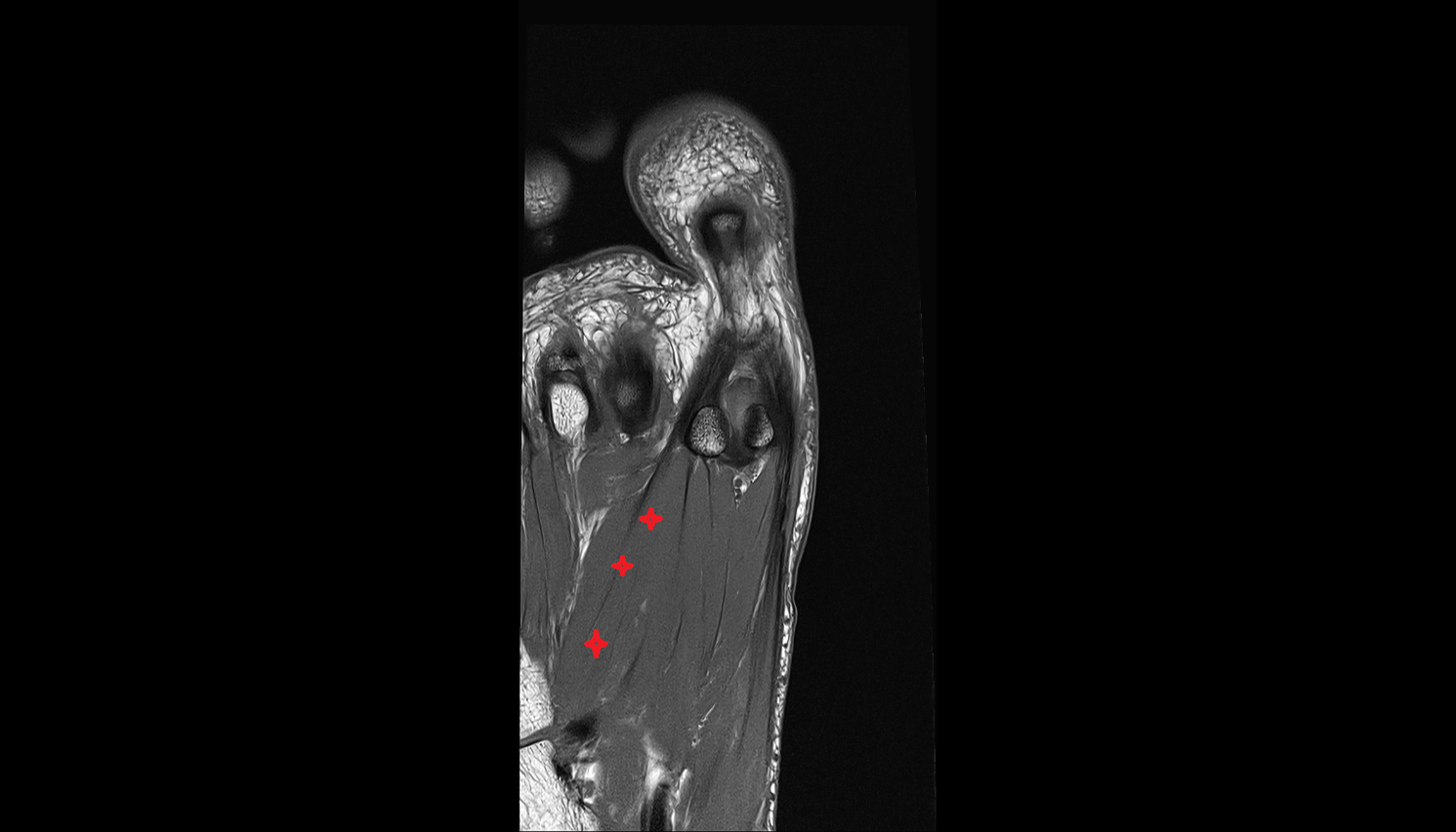 oblique head of Adductor hallucis muscle axial cross sectional anatomy 3T MRI AI enhanced radiology image-img-00000-00000_00001